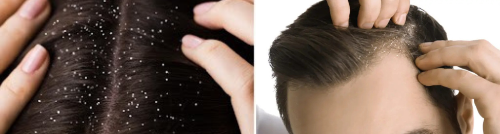 What is hair mist, and how does it works in hair fall and dandruff reduction?